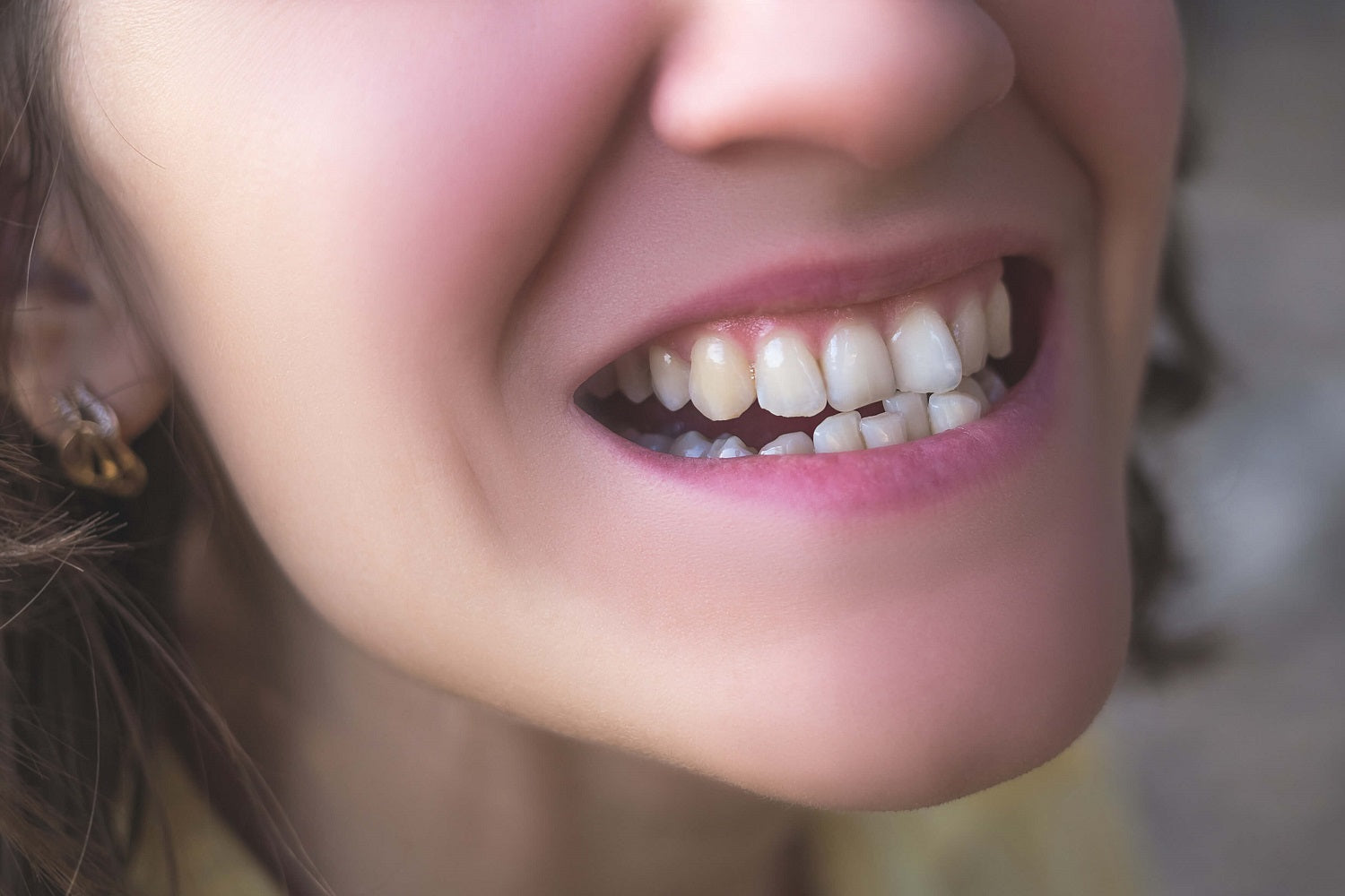 What Causes Crooked Teeth and How to Straighten Them