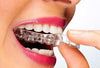 Replacement Aligners